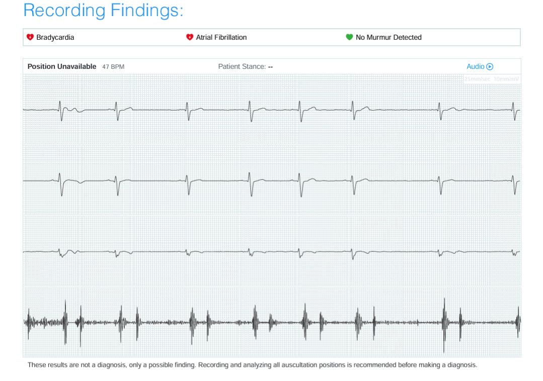 CORE 500™ Digital Stethoscope — 40x Amplification, Active Noise Cancellation, 3-Lead ECG, FDA-Cleared AI with Eko+, Full-Color Display, Reimbursement Eligible — Silver, COR501 - Customer Photo 2