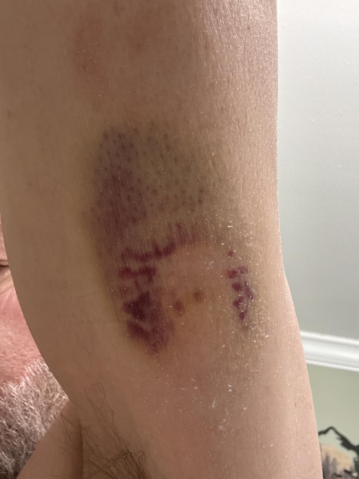 Stelo Glucose Biosensor by Dexcom - 1 Pack (OTC Continuous Glucose Monitor) customer photo 1