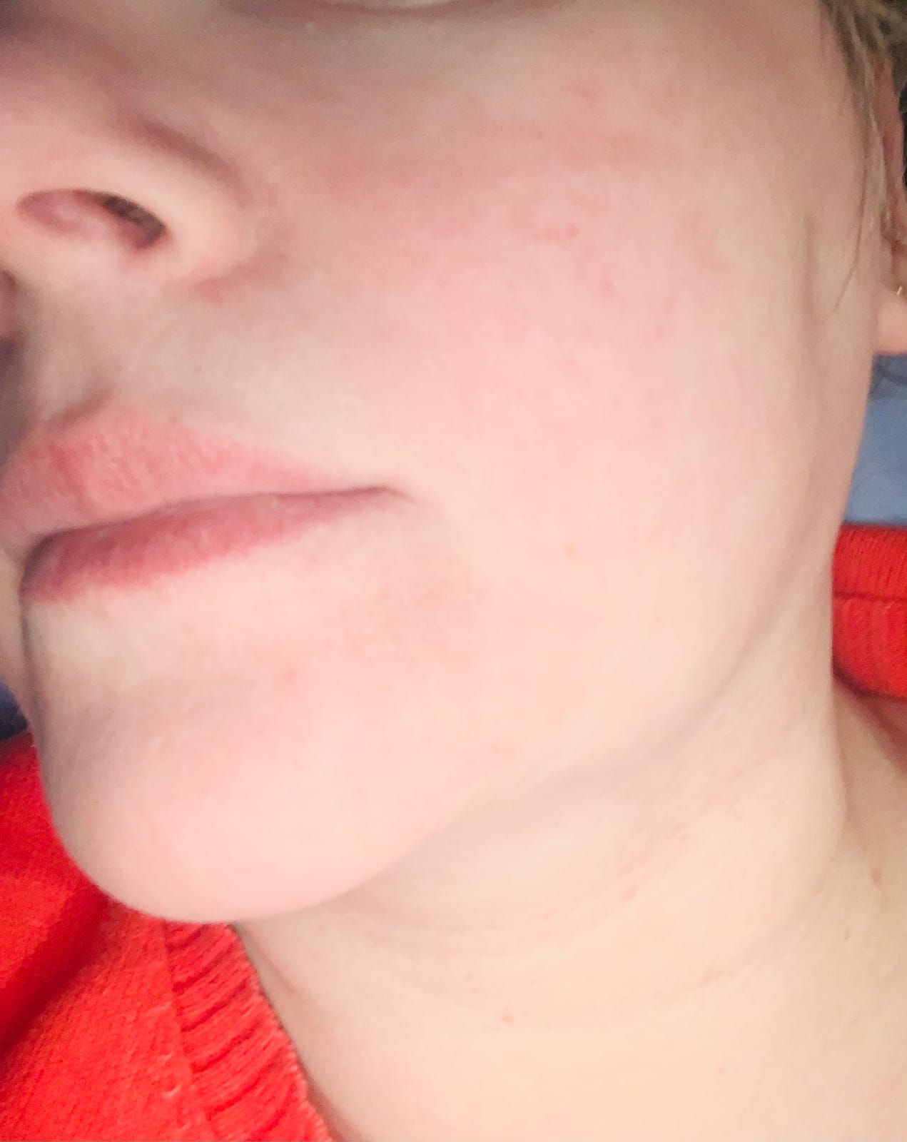 Trophy Skin MicrodermMD - At Home Microdermabrasion Kit - Anti Aging and Acne Treatment - Contains Real Diamond and Pore Extractor Tips to Rejuvenate Skin - White customer photo 2
